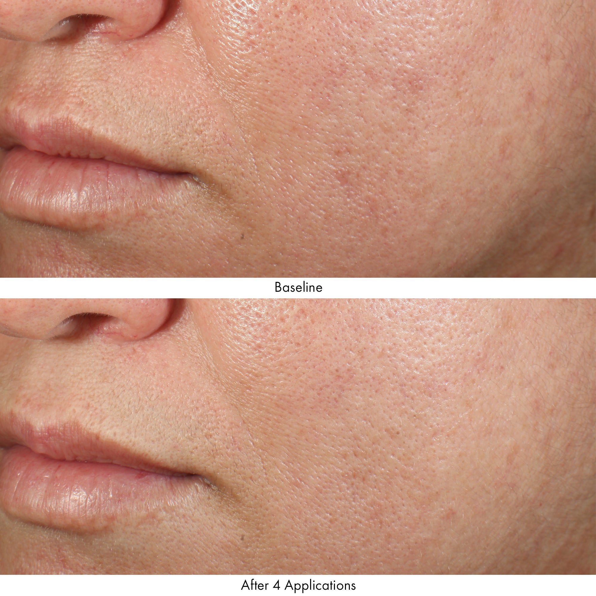 Obagi Revivify Multi-Acid Facial Peel