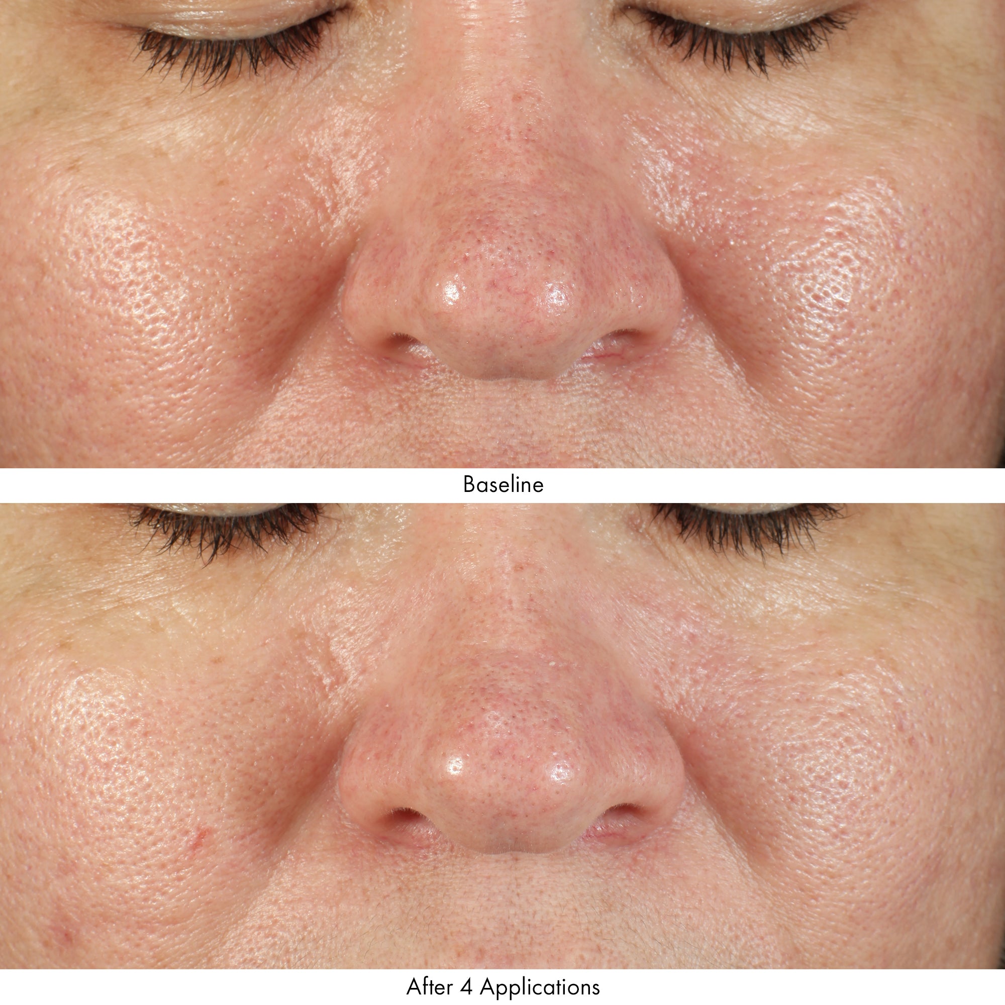 Obagi Revivify Multi-Acid Facial Peel