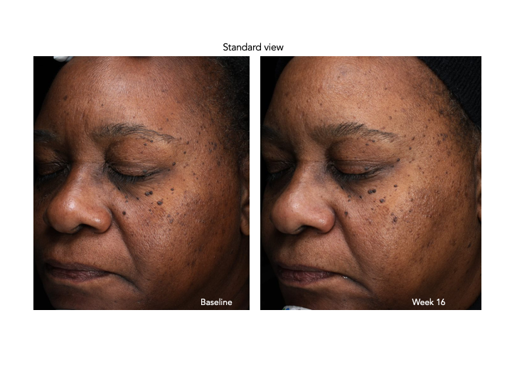 Senté Pigment & Tone Correcting Mask Cysteamine HSA (1.69 oz)