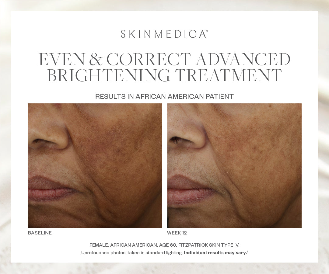 SkinMedica እንኳን እና ትክክለኛ የላቀ ብሩህ ሴረም (2 አውንስ)