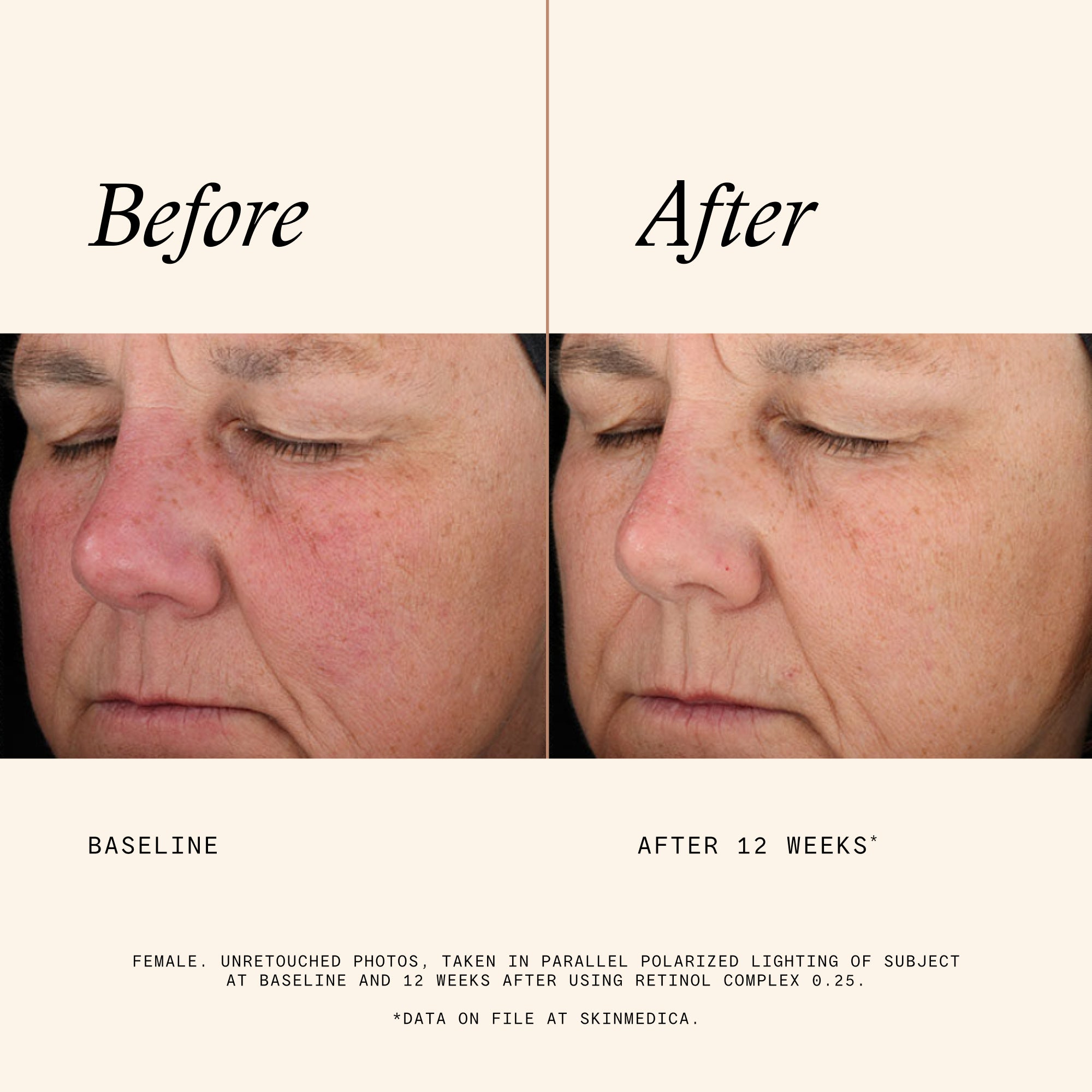 SkinMedica Retinol Complex 0.25 (1 oz)