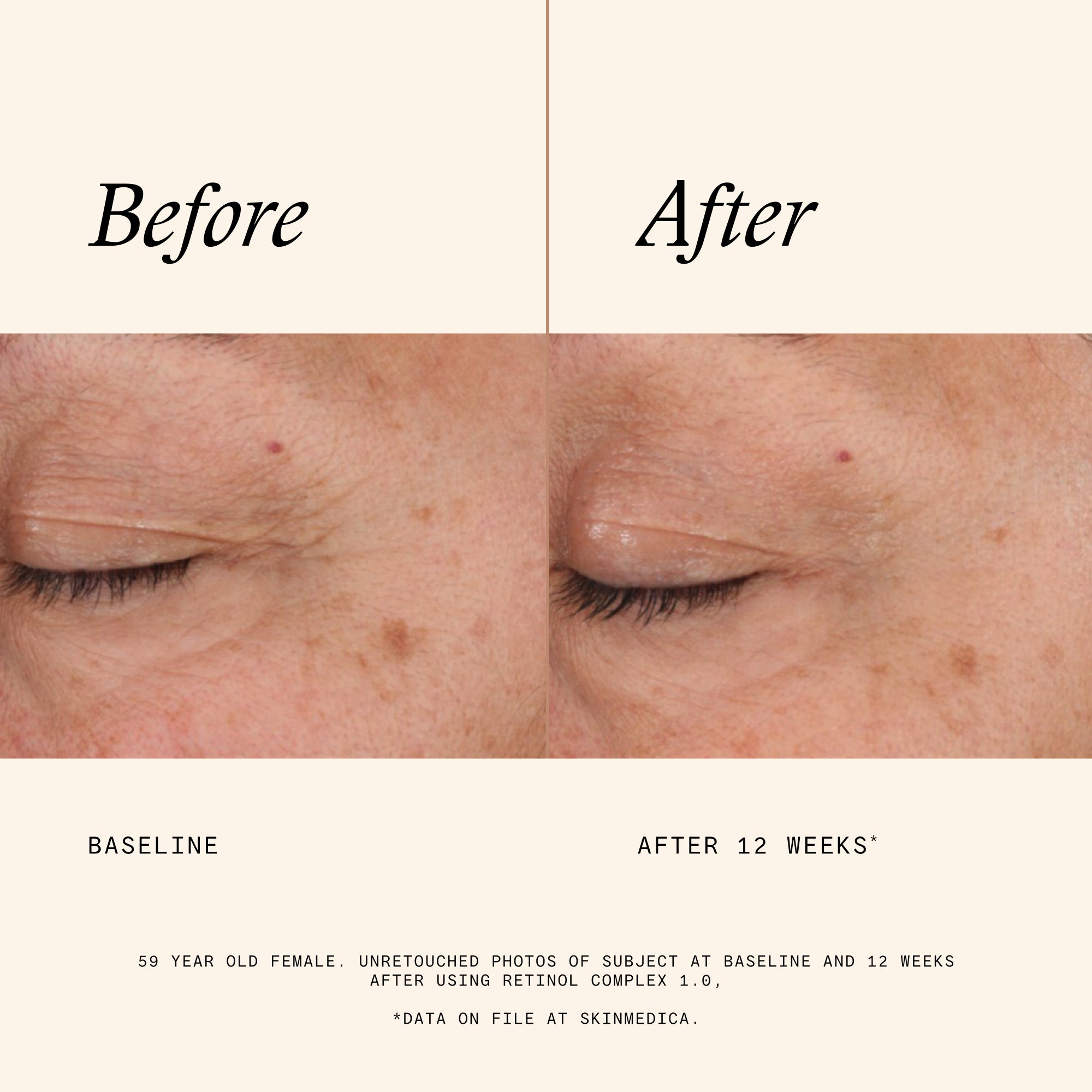 SkinMedica Retinol Complex 1.0 (1 oz)