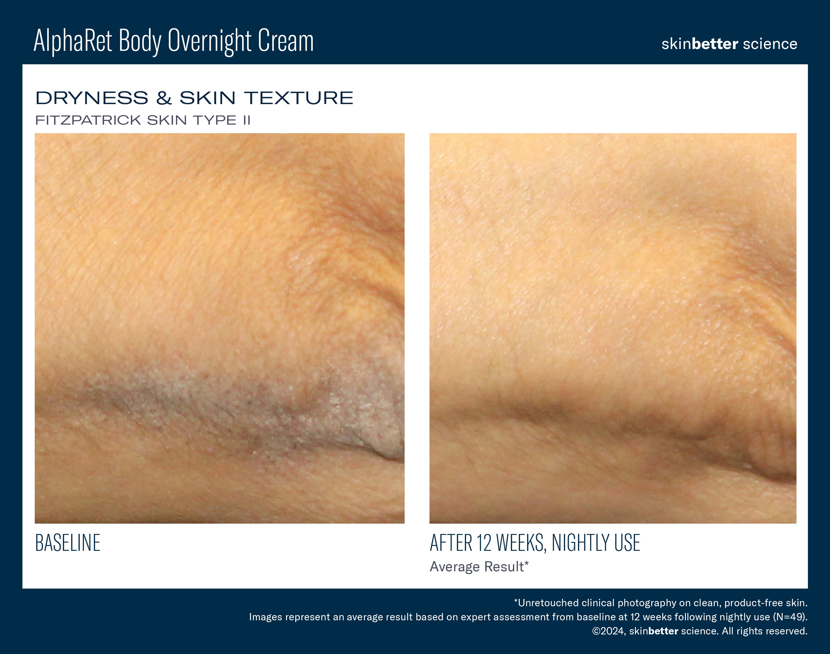 SkinBetter Science AlphaRet Body Overnight Cream (5 oz)