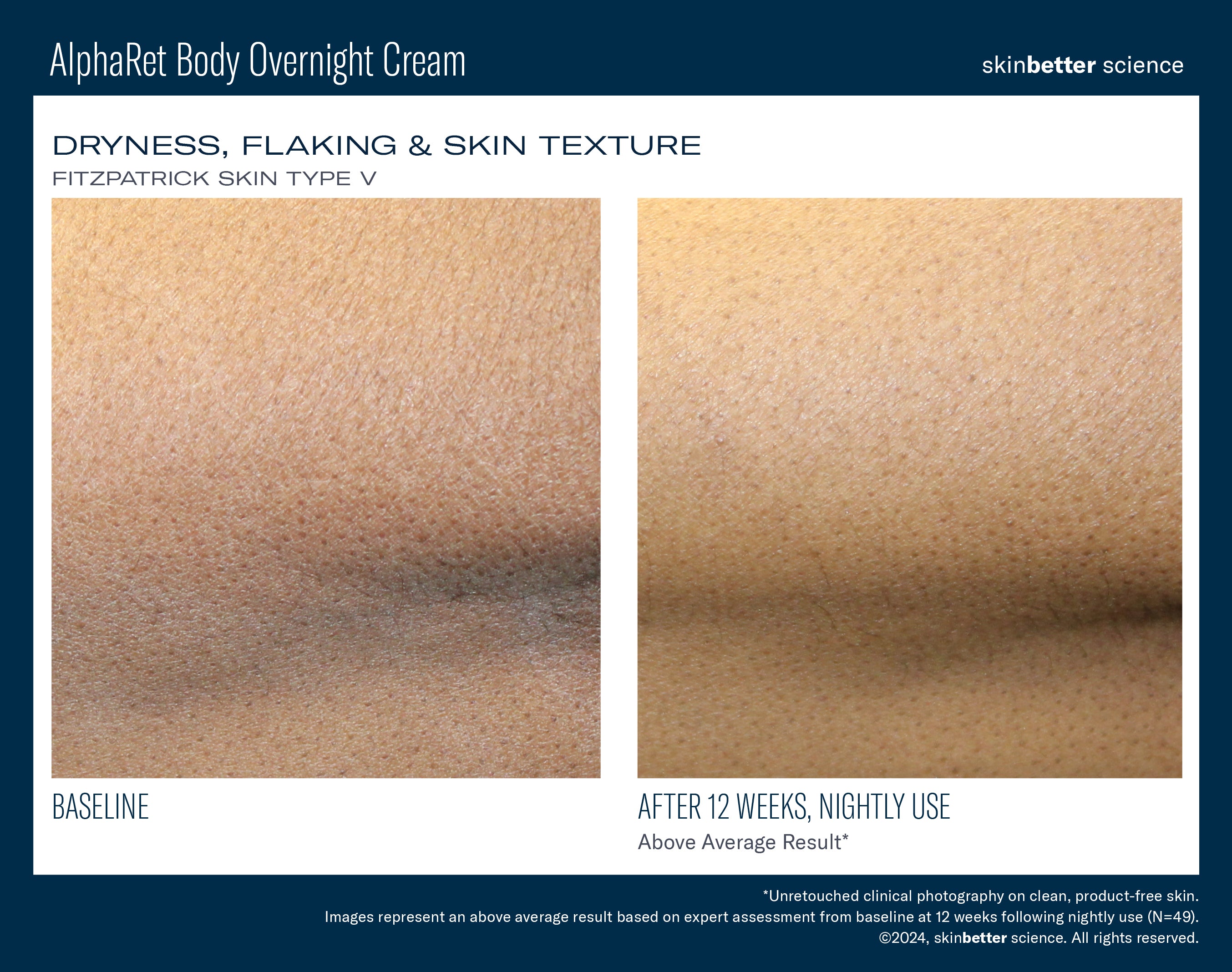 SkinBetter Science AlphaRet Body Overnight Cream (5 oz)