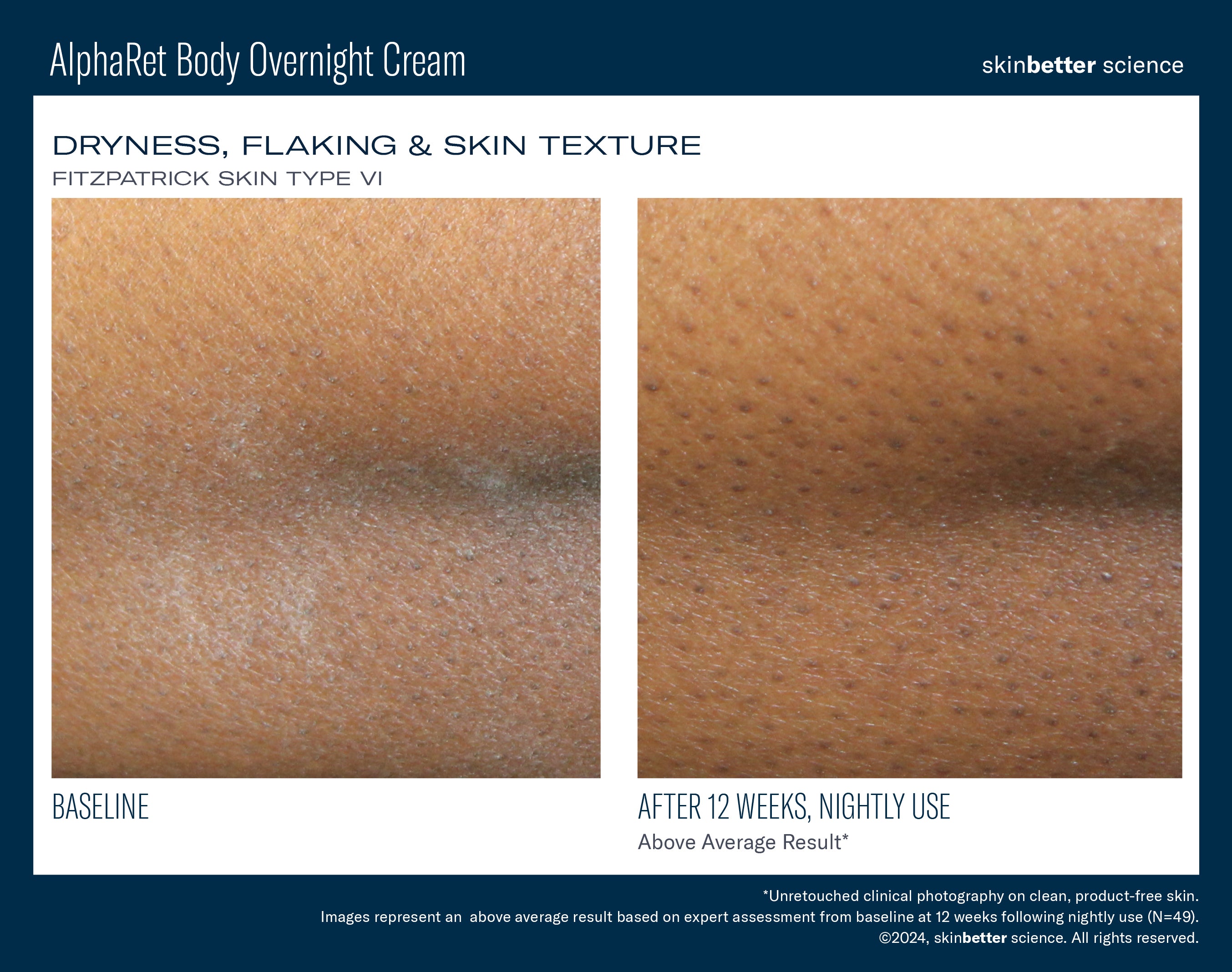 SkinBetter Science AlphaRet Body Overnight Cream (5 oz)