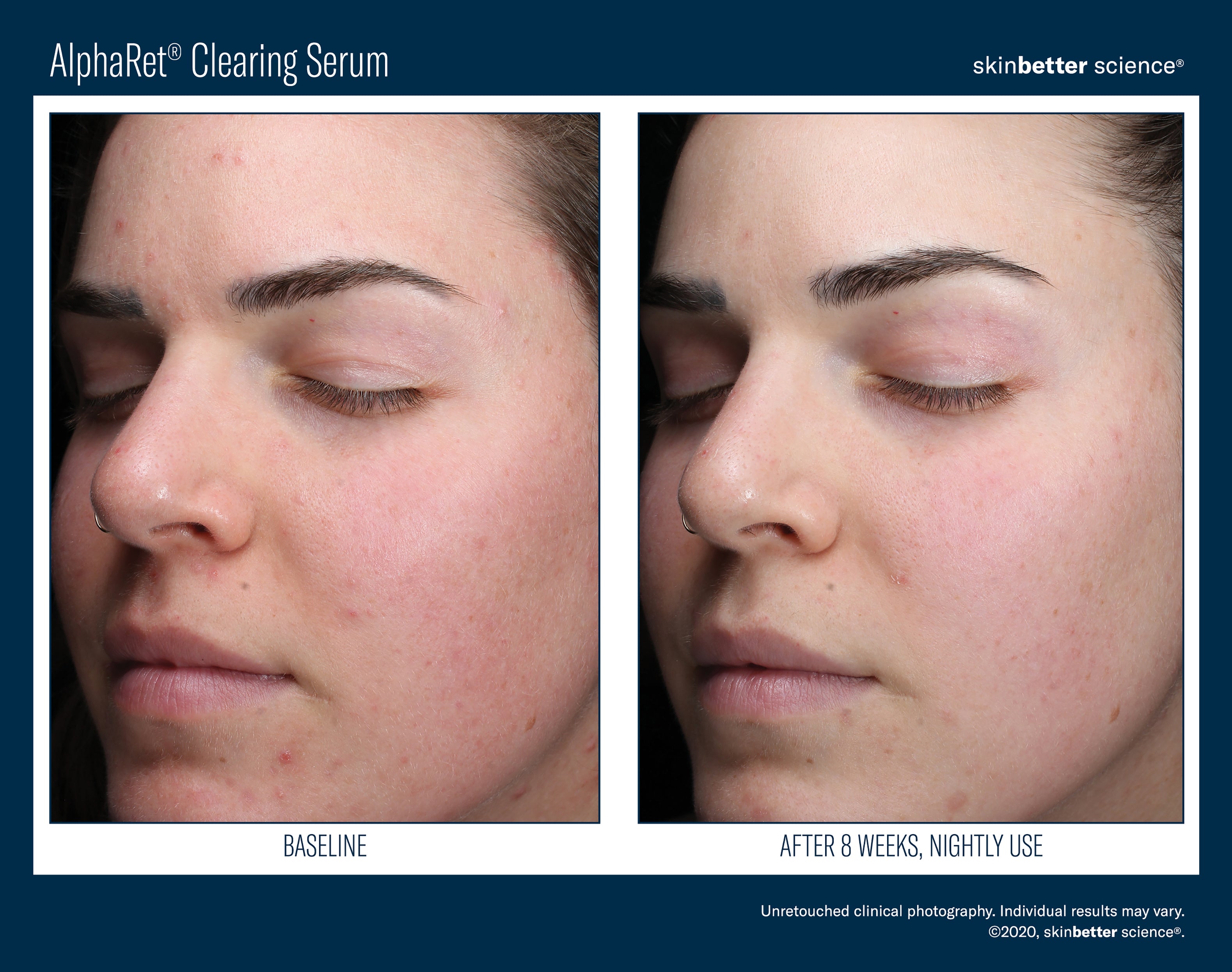 SkinBetter Science AlphaRet Clearing Serum (1 oz)