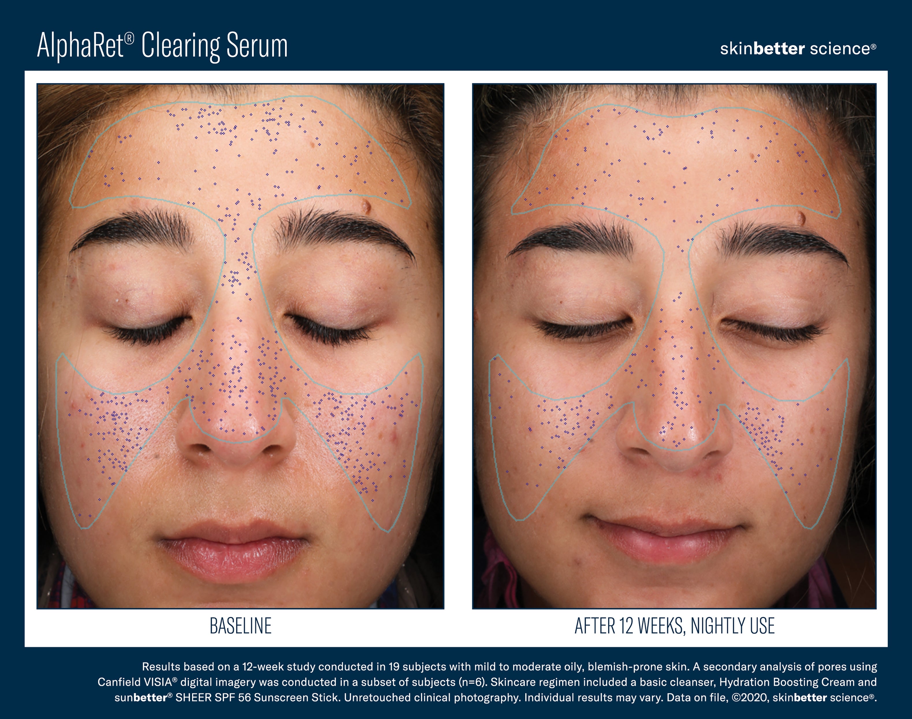 SkinBetter Science AlphaRet Clearing Serum (1 oz)