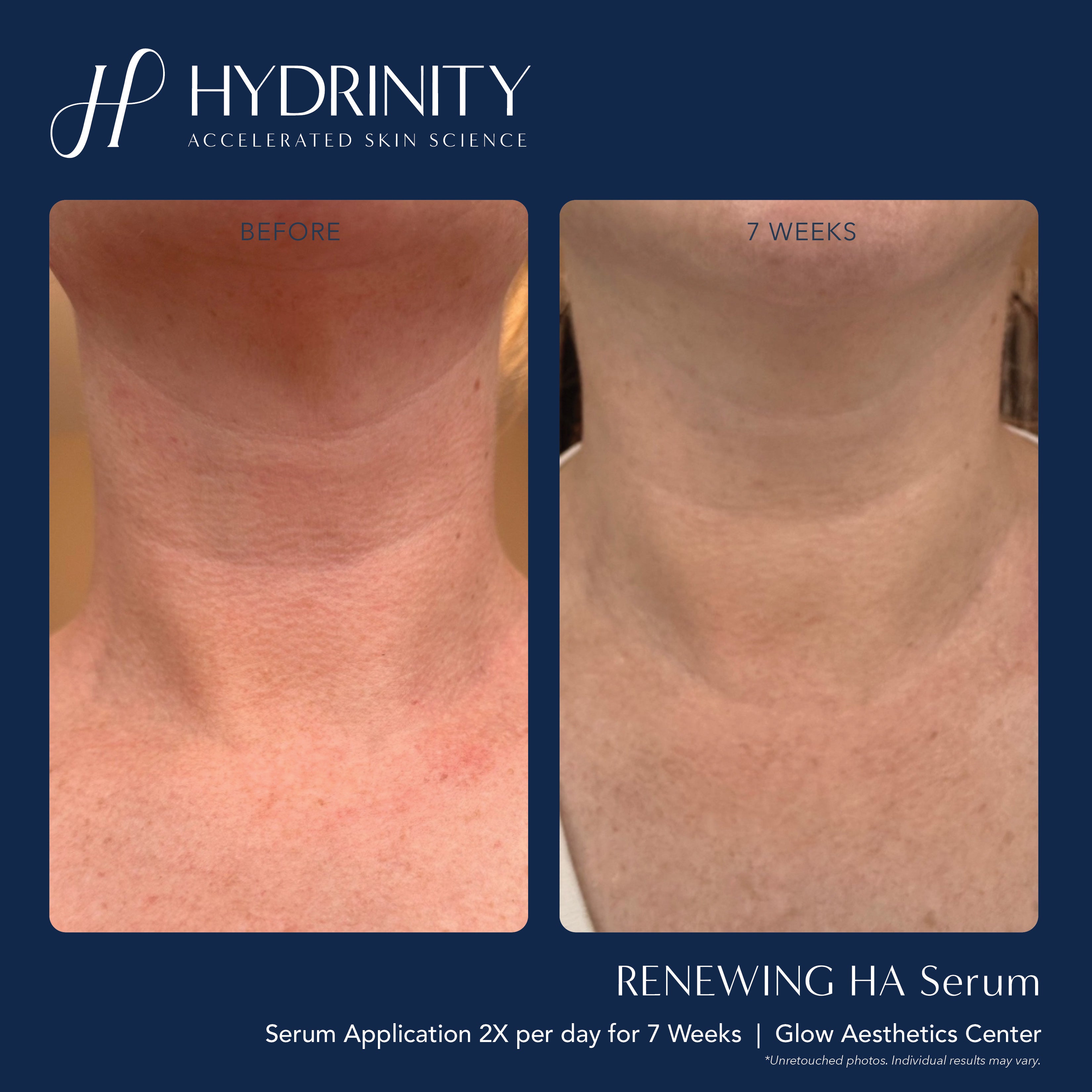 Hydrinity Renewing HA Serum (1 oz)