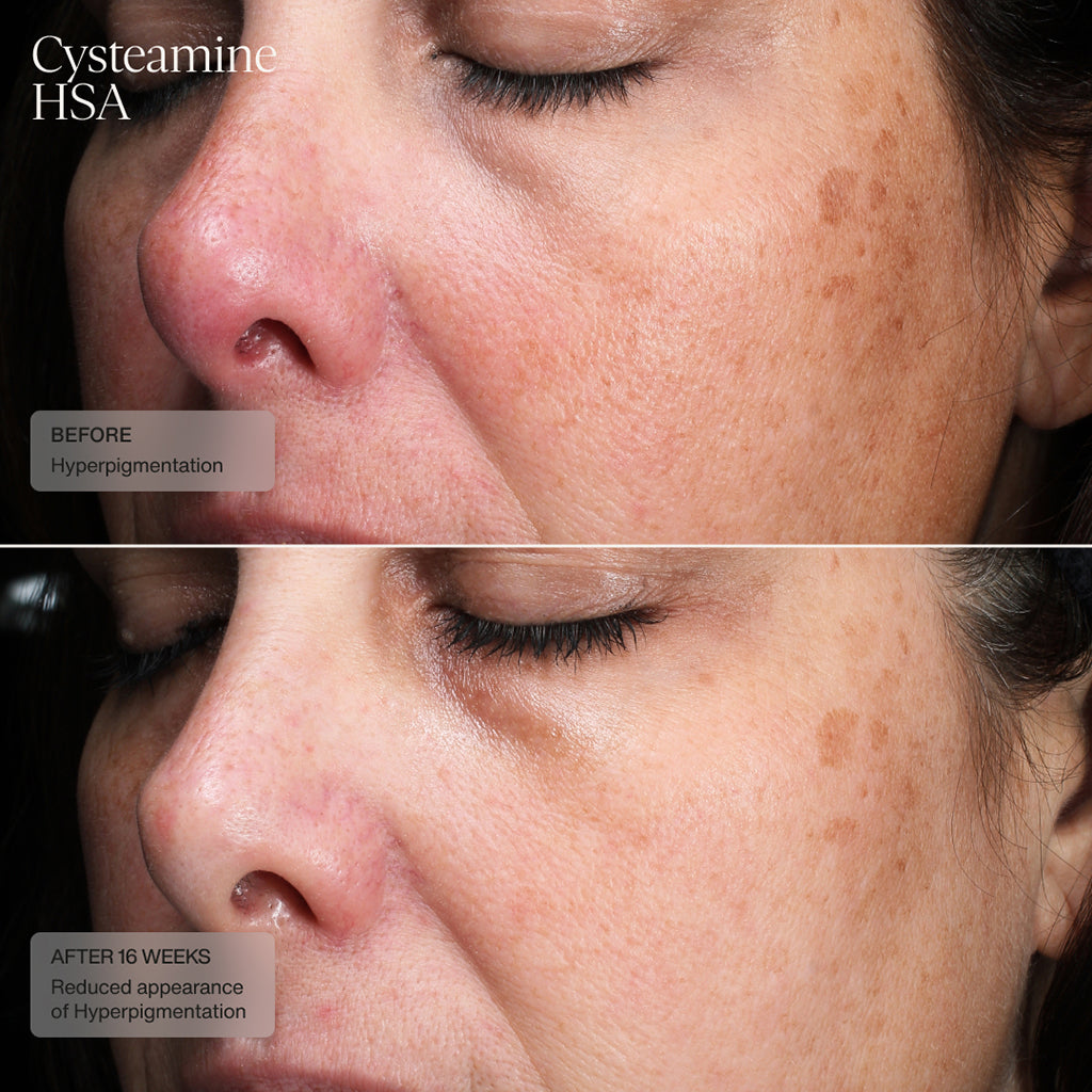 Senté Cysteamine HSA Pigment & Tone Corrector (1.69 oz) & Serum Bio Complete Serum (0.33 oz) Duo