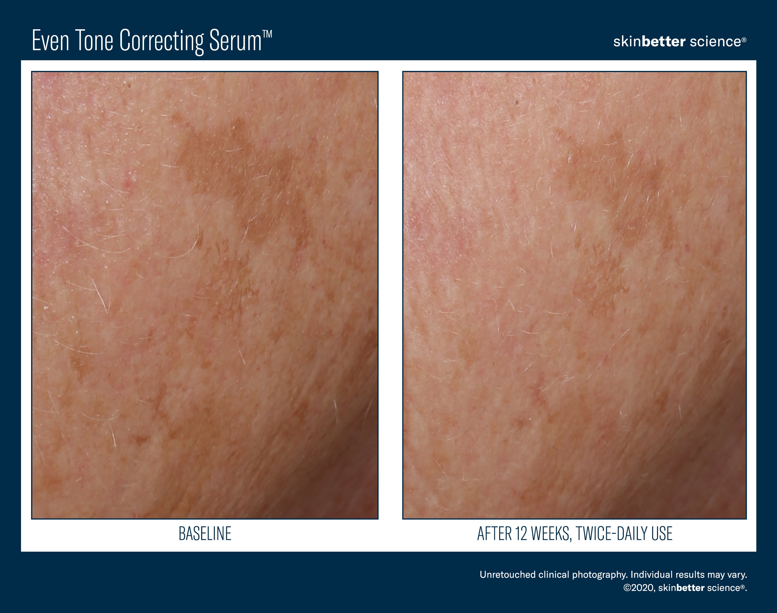 SkinBetter Science Even Tone Correcting Serum (1.69 oz)