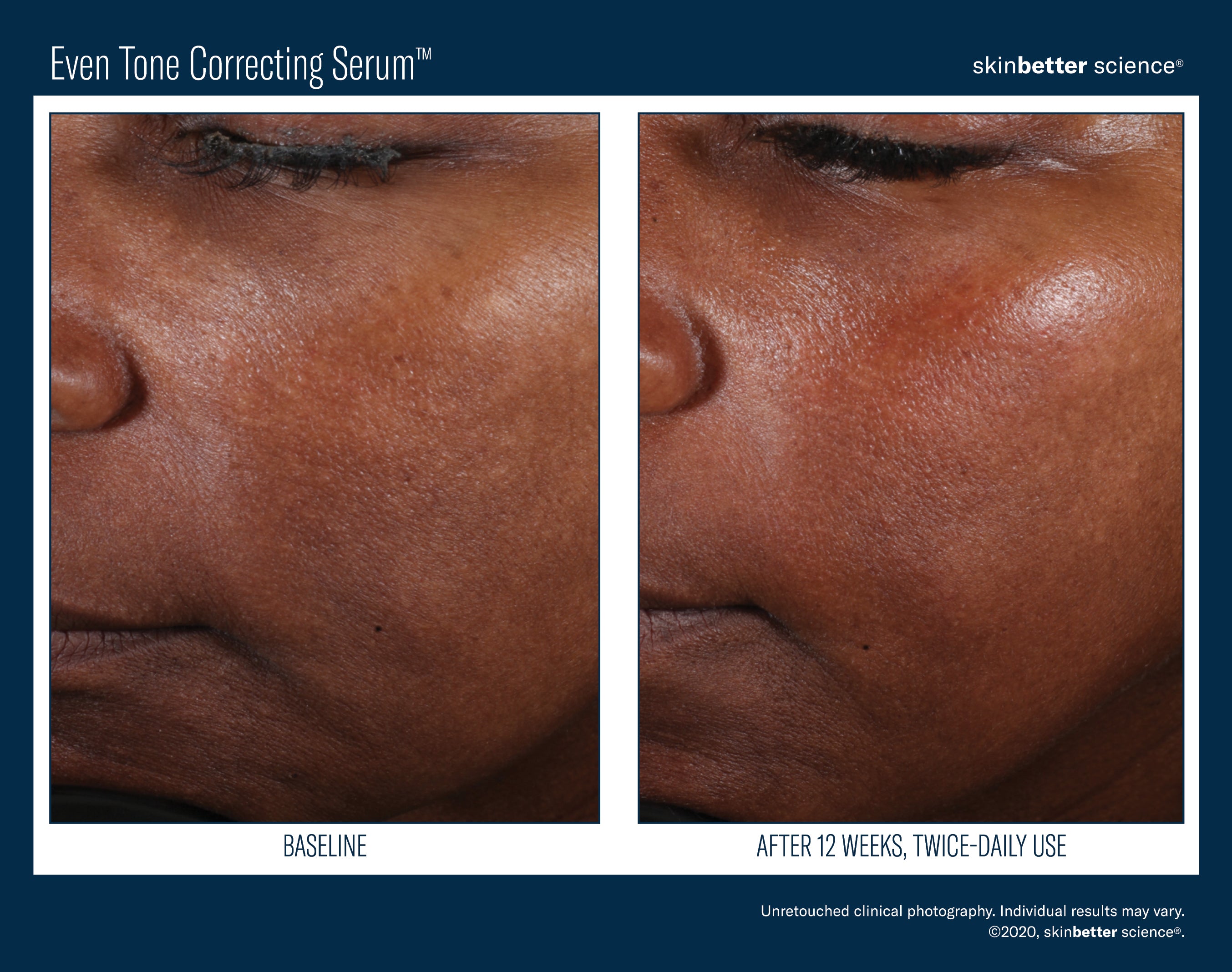 SkinBetter Science Even Tone Correcting Serum (1.69 oz)