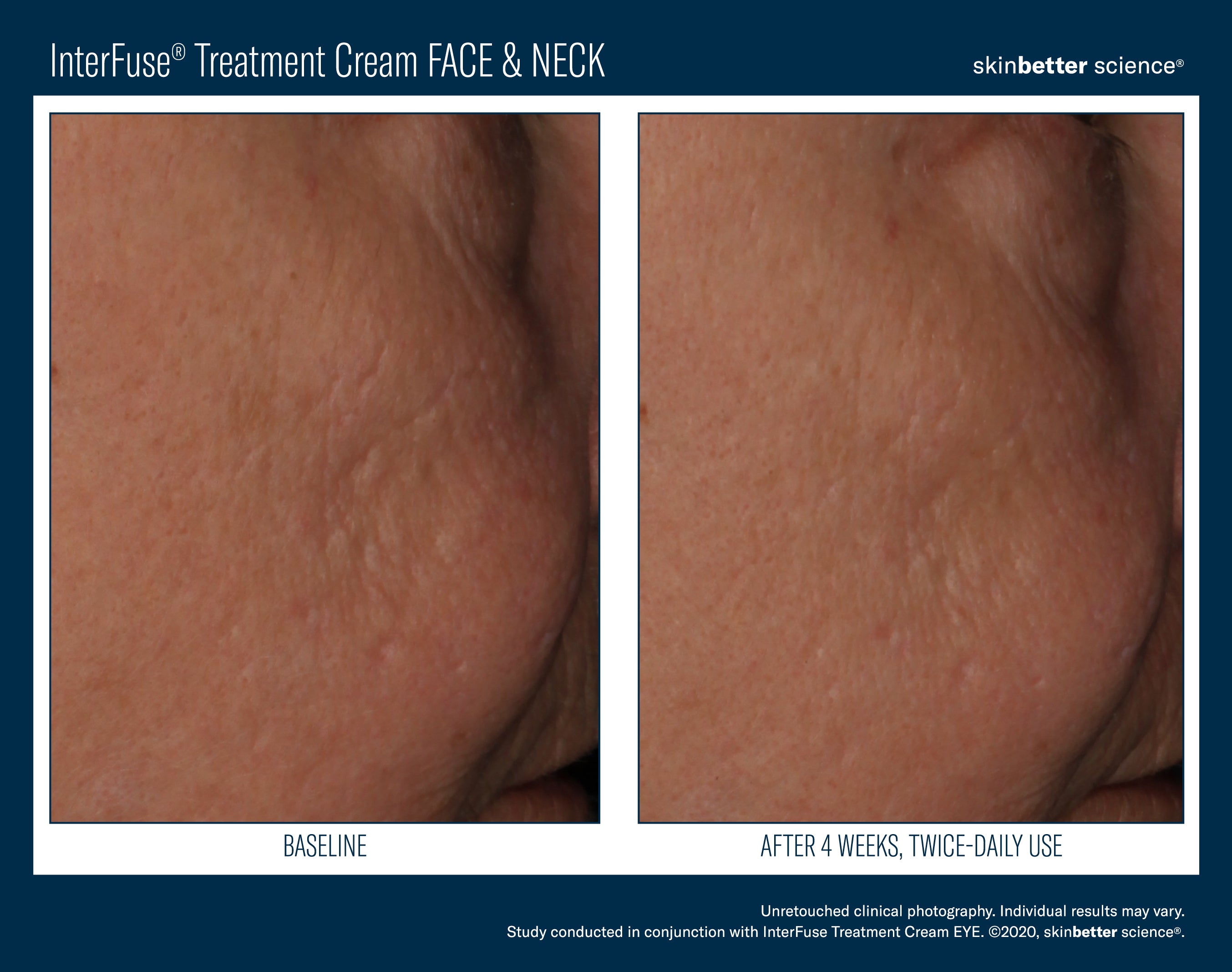 SkinBetter Science InterFuse Treatment Cream Face & Neck (1.69 oz)