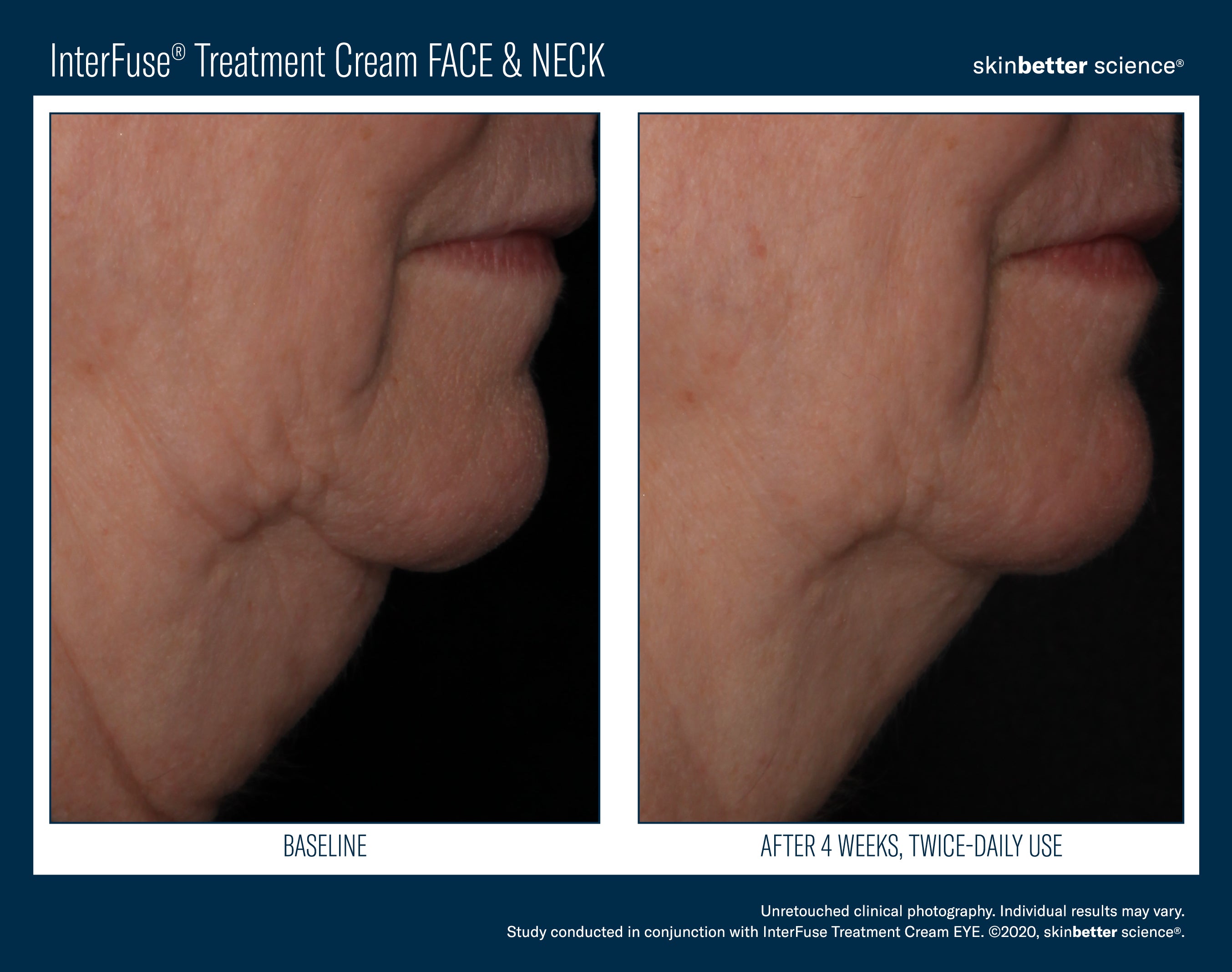 SkinBetter Science InterFuse Treatment Cream Face & Neck (1 oz)