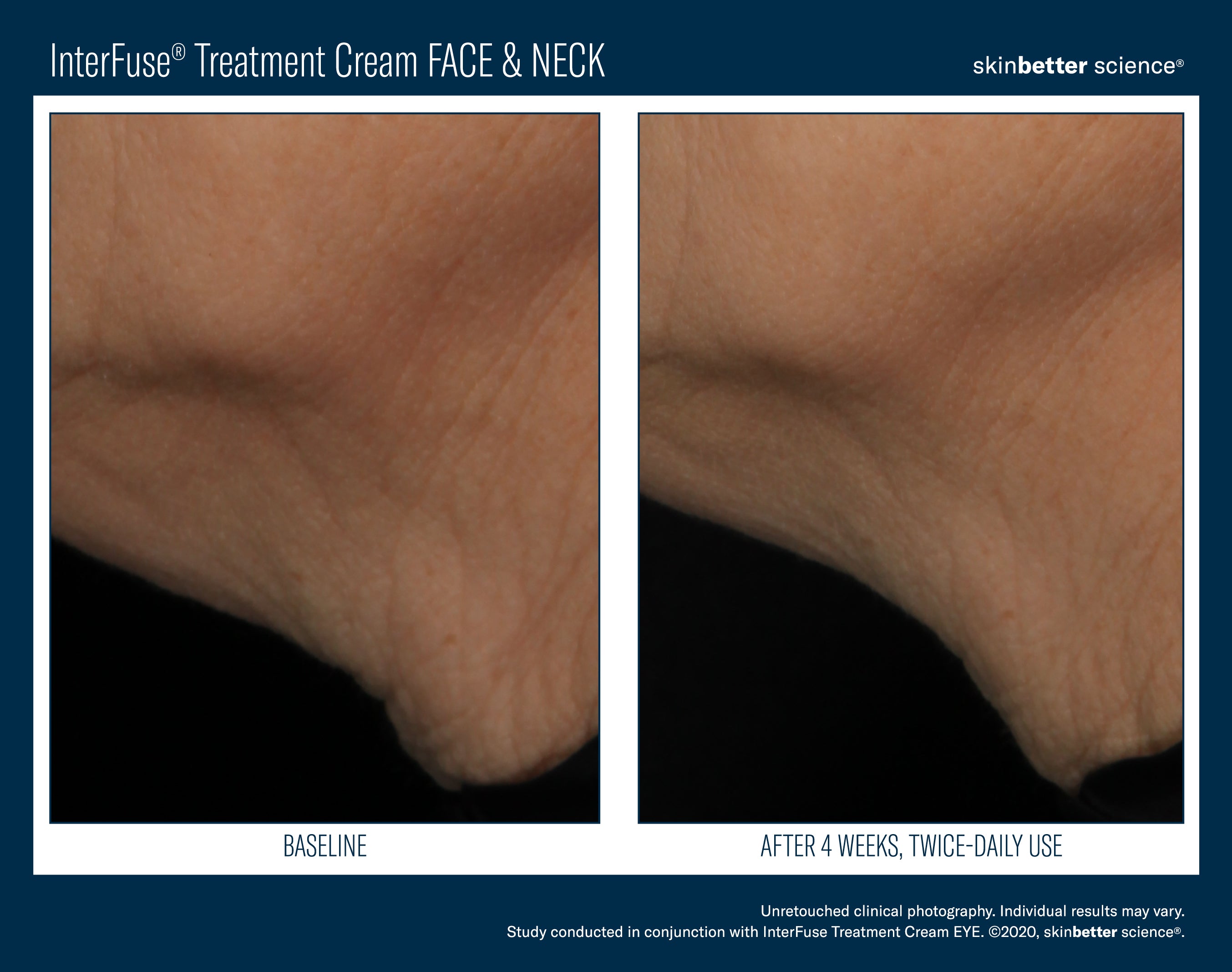 SkinBetter Science InterFuse Treatment Cream Face & Neck (1 oz)