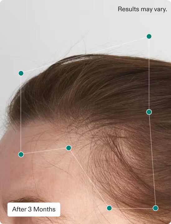 Nutrafol կանանց հավասարակշռության մազերի աճի փաթեթ