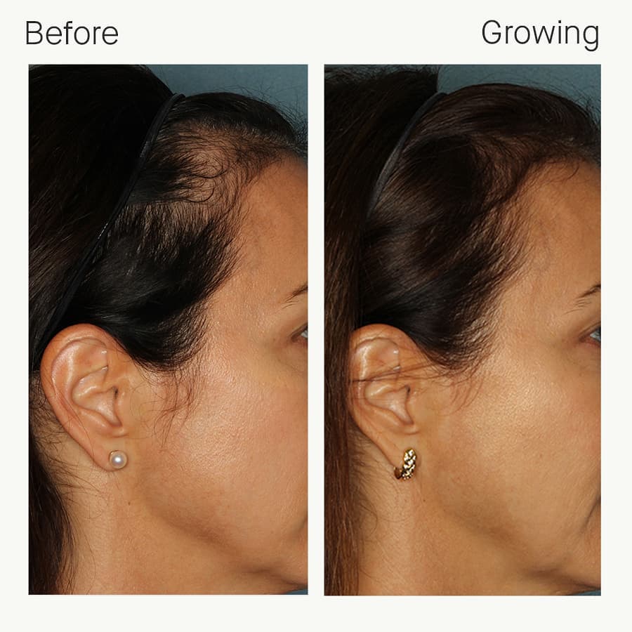 Nutrafol Γυναικεία Hair Growth Nutraceutical (120 κάψουλες)