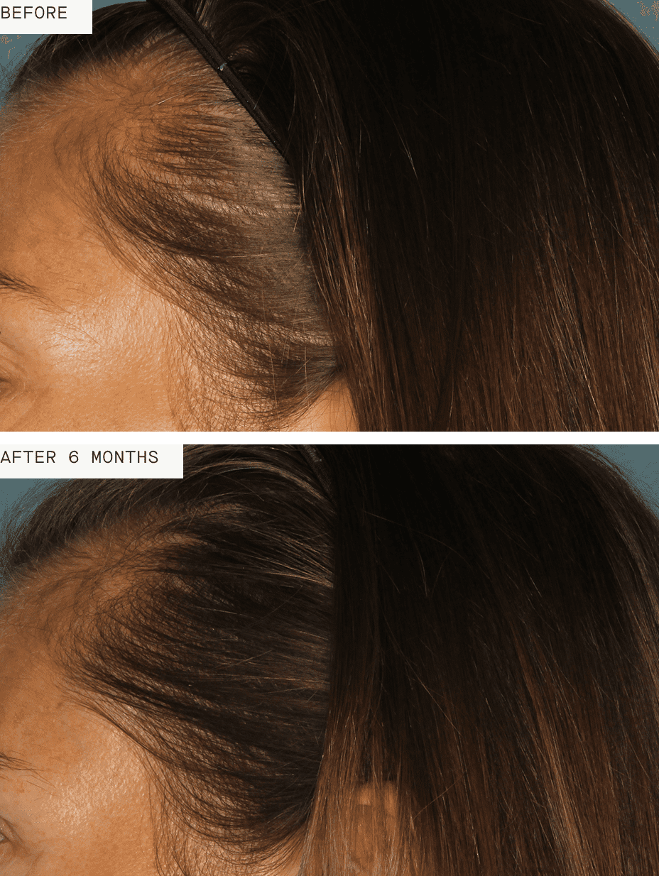 Nutrafol komplet za popolno rast las za ženske