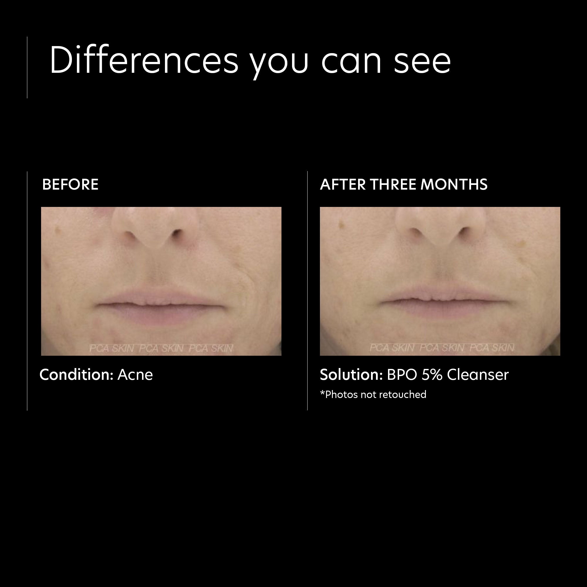 PCA Skin BPO Cleanser (7 oz)