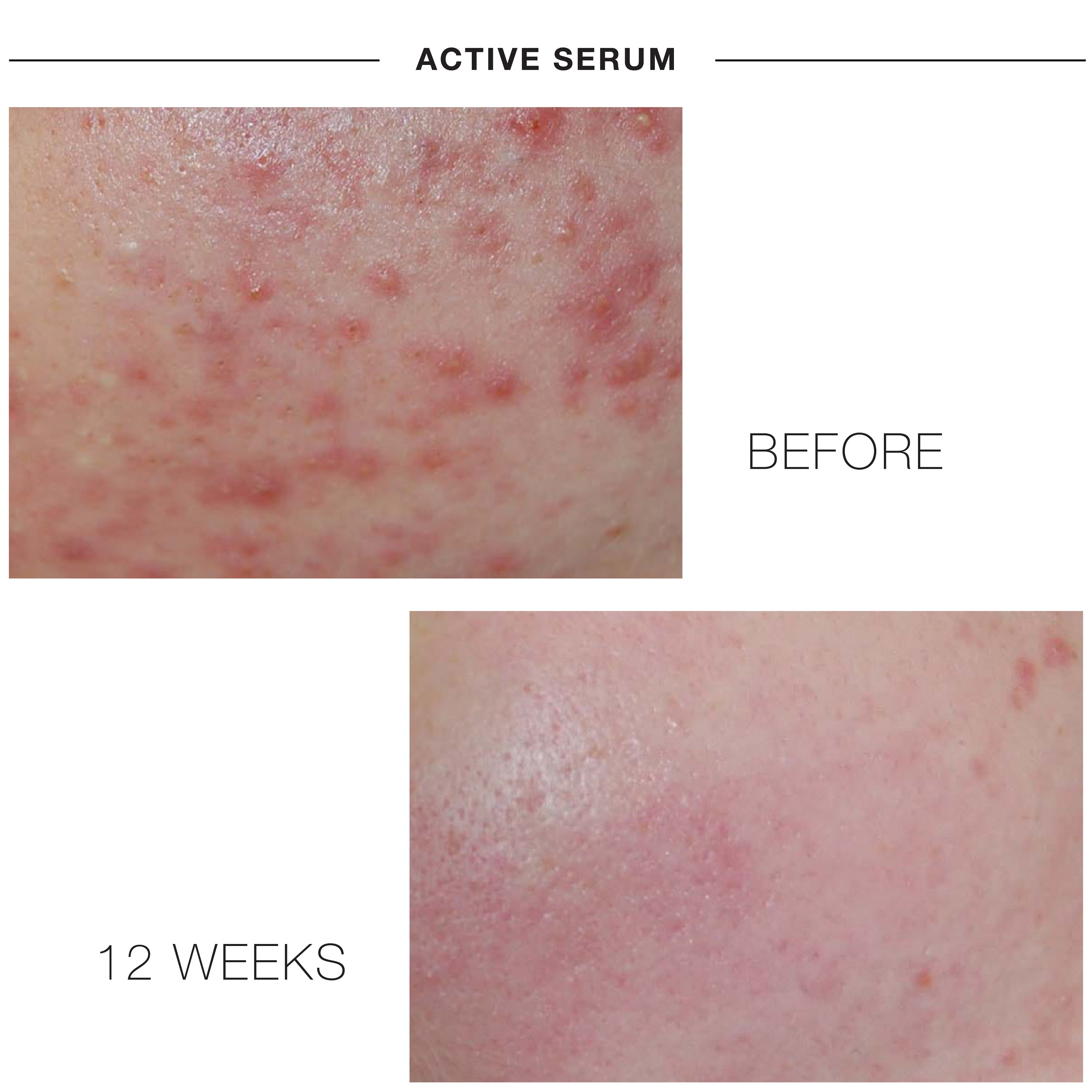 iS Clinical Active Serum (oz 1)