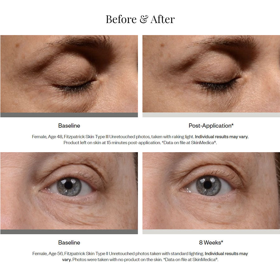 SkinMedica Instant Bright Eye Cream før og etter