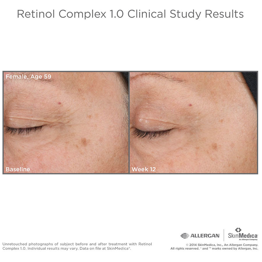 SkinMedica Retinol Complex 1.0 Resultados antes e despois