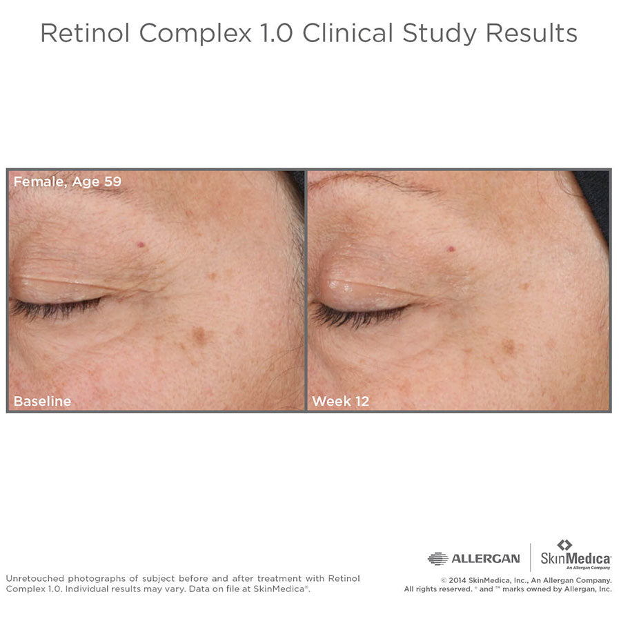 SkinMedica Retinol Complex 1.0 resultater før og etter