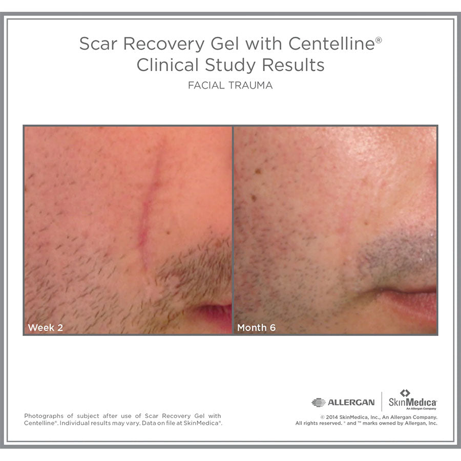 SkinMedica Scar Recovery Gel med Centelline før og etter