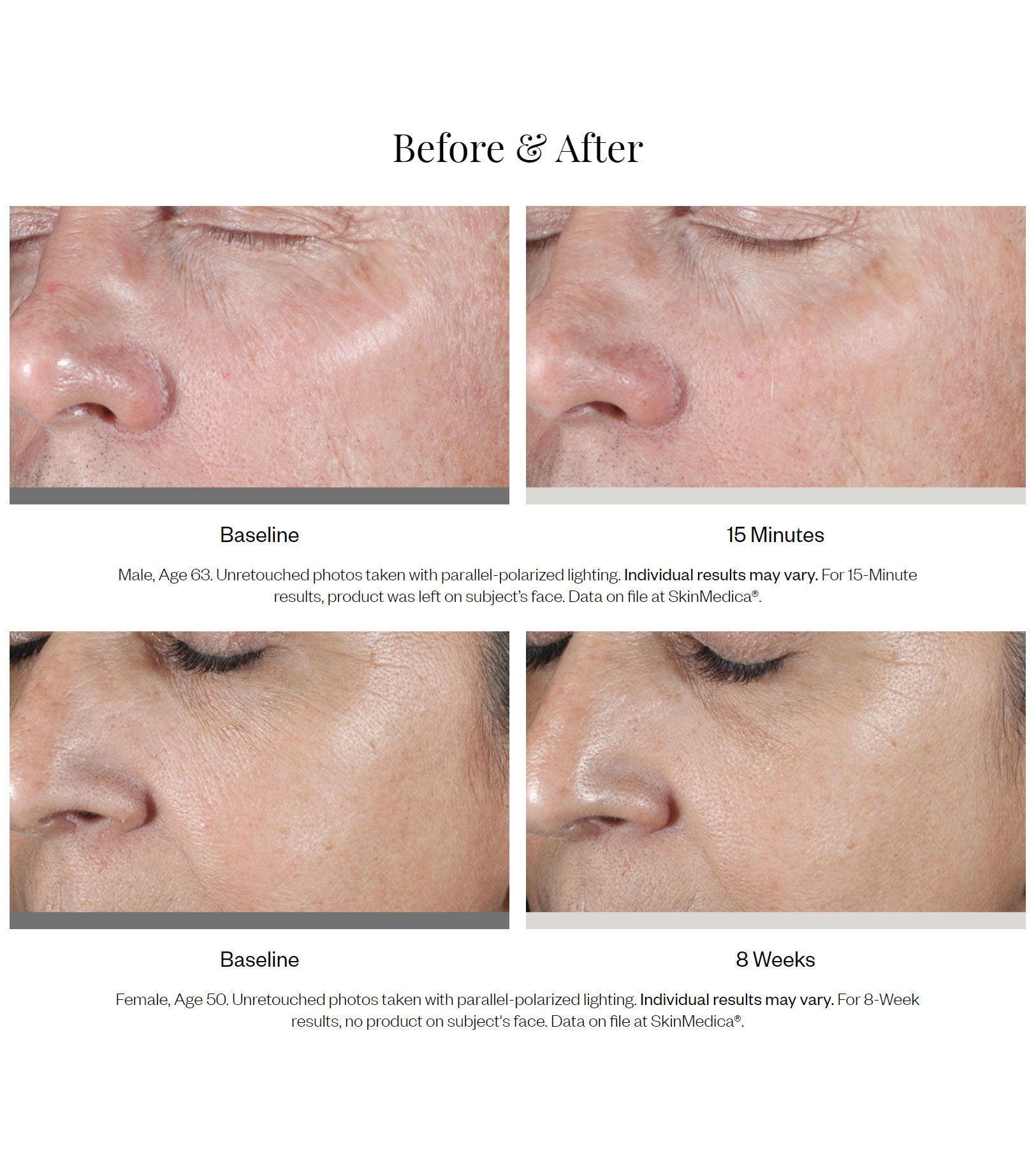 Virker Skinmedica HA5 faktisk - før og efter billeder af HA5 Rejuvenating Hydrator fra SkinMedica