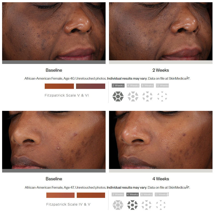 Virker SkinMedica Lytera 2.0 Pigment Correcting Serum? Før og etter bilder